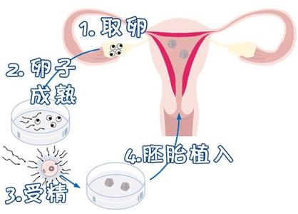 找卵代生子机构